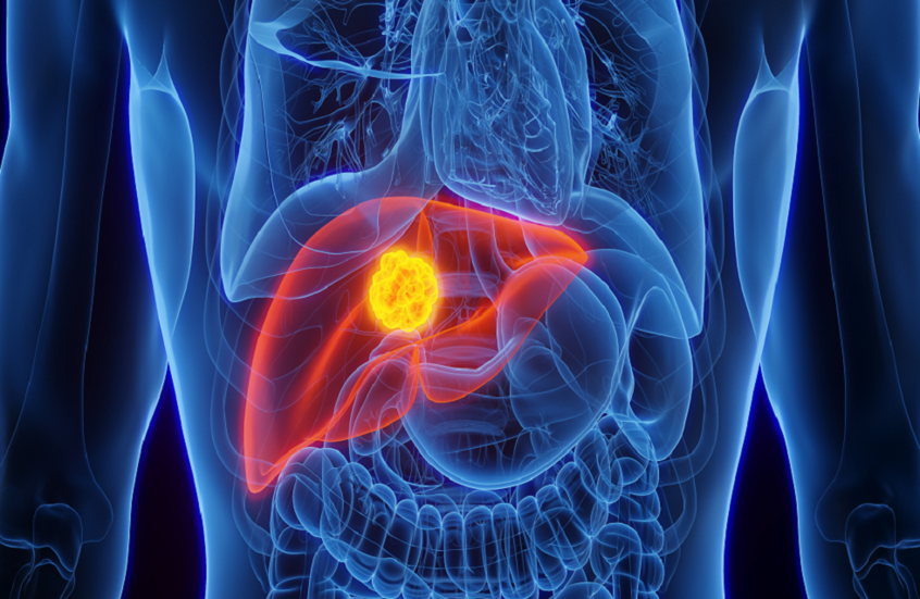 ولاحظ الباحثون أن الأشخاص الذين يمارسون الرياضة ويتمتعون بمعدلات نشاط بدني عالية كانوا أقل عرضة للوفاة بأمراض الكبد بنسبة 36% مقارنة بغيرهم. كما أن اتباع نظام غذائي صحي قلل خطر الوفاة بأمراض الكبد بنسبة 80%. وعلى الرغم من أن النساء أكثر عرضة للإصابة بأمراض الكبد المرتبطة بالكحول، فإن ممارسة الرياضة واتباع نظام غذائي صحي منحاهن حماية فعالة.  ويشير الباحثون إلى أن الجمع بين الخضراوات والفواكه والحبوب والمأكولات البحرية والبروتينات النباتية ضمن النظام الغذائي، إلى جانب ممارسة التمارين الرياضية بانتظام في الهوا