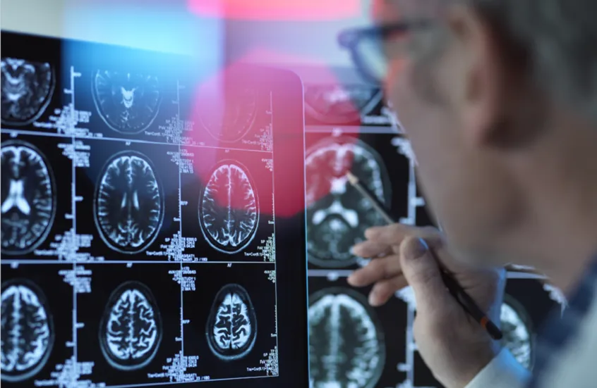 علماء يكتشفون مركبات طبيعية يمكن أن تحمي الدماغ من ألزهايمر