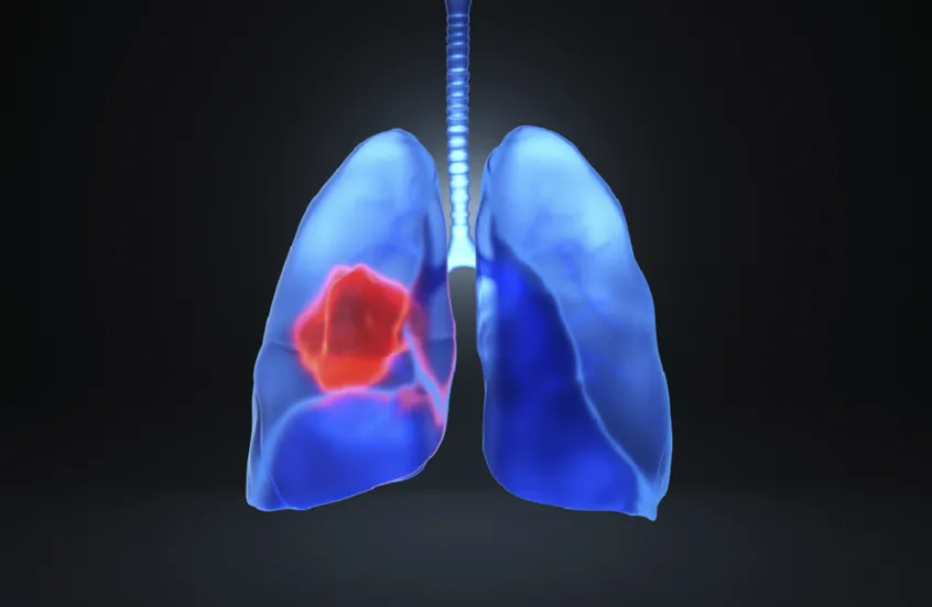 دراسة تكشف دور الالتهاب في المراحل المبكرة من سرطان الرئة