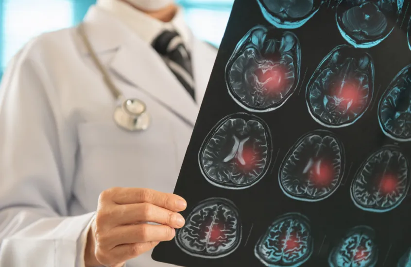 باحثو كامبريدج يبتكرون جهاز "Revoice" لإعادة النطق لمرضى السكتة الدماغية دون جراحة